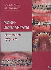 Мини-имплантаты. Ортодонтия будущего.