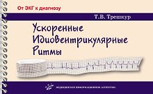 Ускоренные идиовентрикулярные ритмы