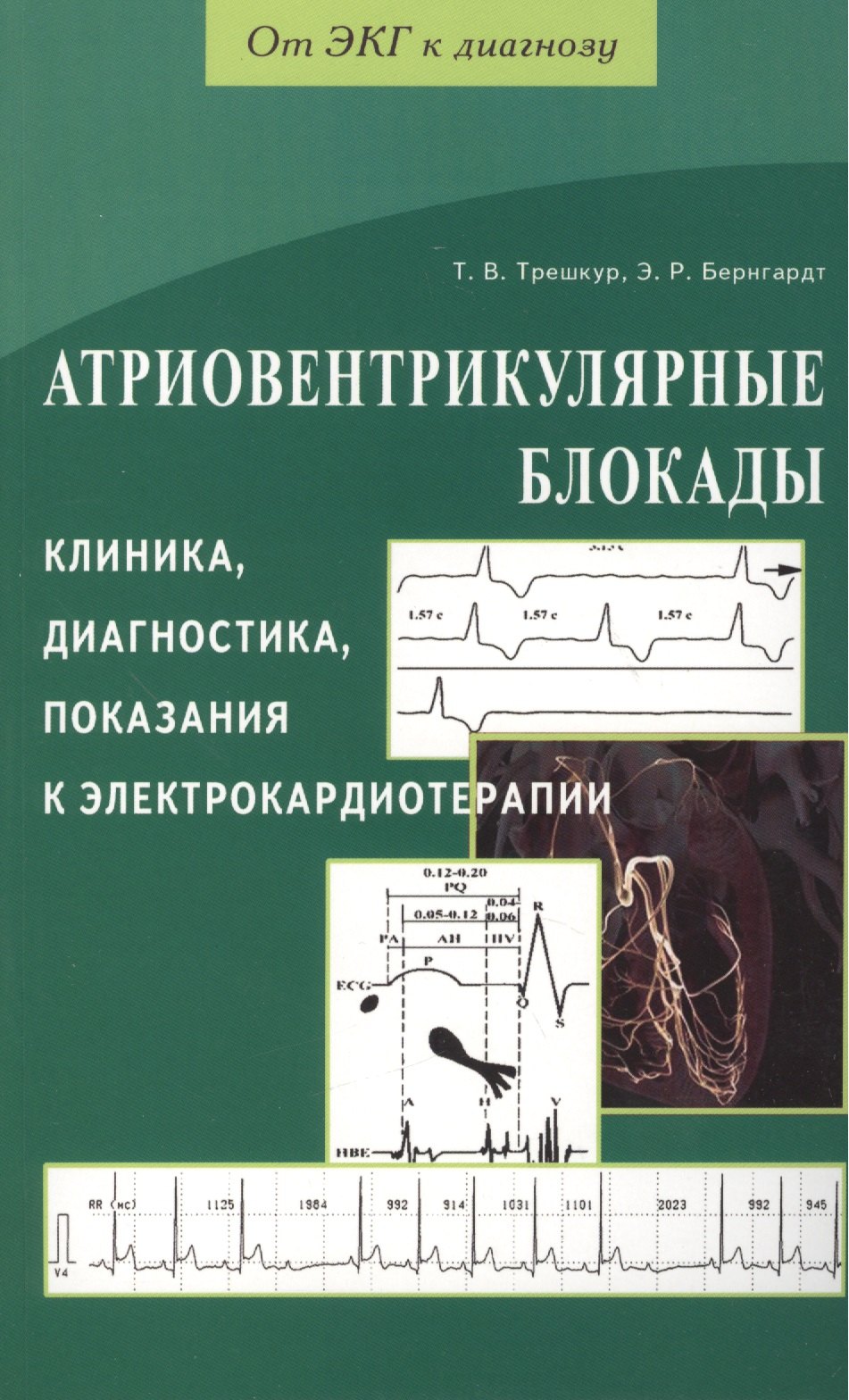 Атриовентрикулярные блокады. Клиника, диагностика, показания к электрокардиотерапии
Атриовентрикулярные блокады. Клиника, диагностика, показания к электрокардиотерапии