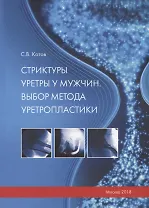 Стриктуры уретры у мужчин. Выбор метода уретропластики