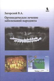 Ортопедическое лечение заболеваний пародонта