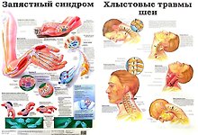 Плакат (мед) Запястный синдром / Хлыстовые травмы шеи (550) (А)