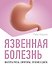 Язвенная болезнь. Факторы риска, симптомы, лечение и диета - 0