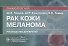 Рак кожи. Меланома - 0