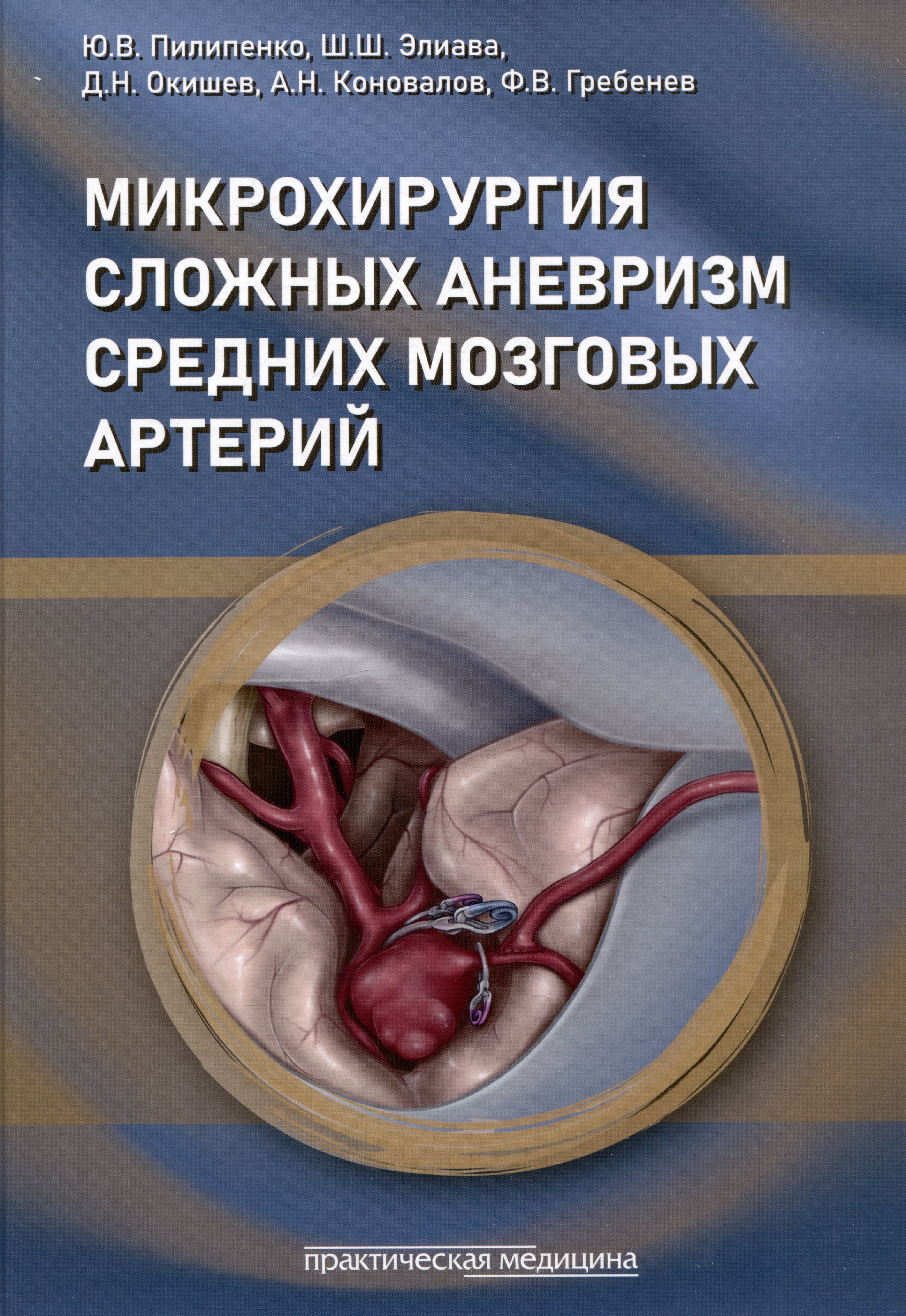 

Микрохирургия сложных аневризм средних мозговых артерий: крупных, гигантских, фузиформных и частично тромбированных