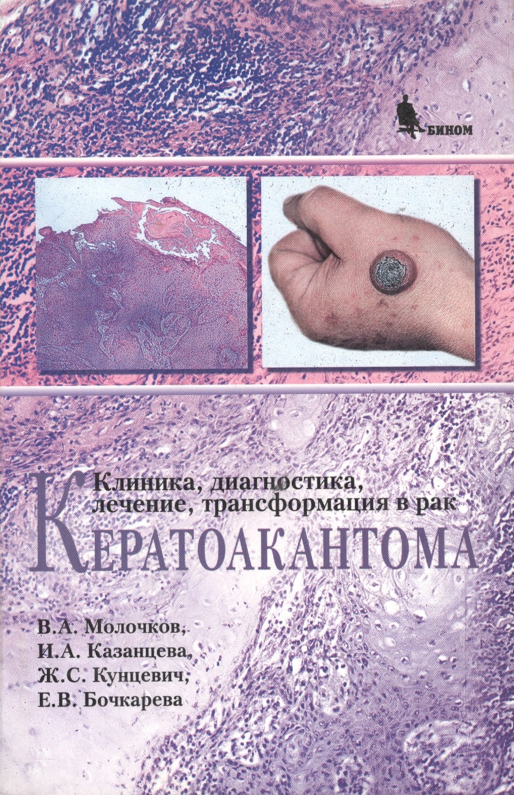 

Кератоакантома. Клиника, диагностика, лечение, трансформация в рак