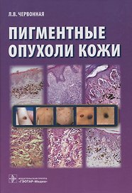 Пигментные опухоли кожи