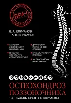 Остеохондроз позвоночника