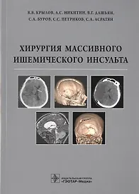 Хирургия массивного ишемического инсульта