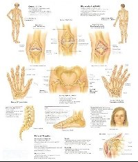 Плакат (70х108) Артрит-воспаление суставов / Воспалительные нарушения тазобедренного и коленного суставов (А)