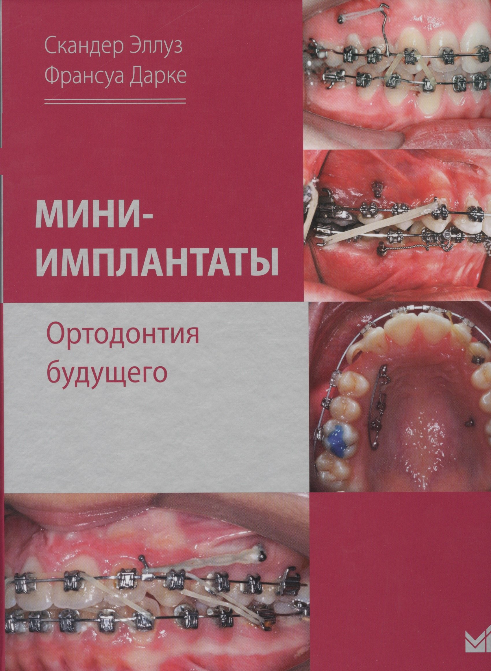 

Мини-имплантаты. Ортодонтия будущего.