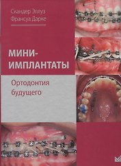 Мини-имплантаты. Ортодонтия будущего.