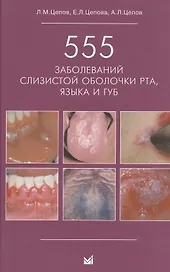 555 заболеваний слизистой оболочки рта, языка и губ