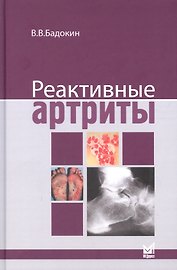 Реактивные артриты