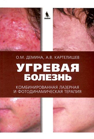 Анатолий Васильевич Картелишев, Ольга Михайловна Демина Угревая болезнь. Комбинированная лазерная и фотодинамическая терапия