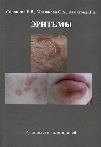Е. В. Сорокина, Нэлли Кимовна Ахматова Эритемы. Руководство для врачей